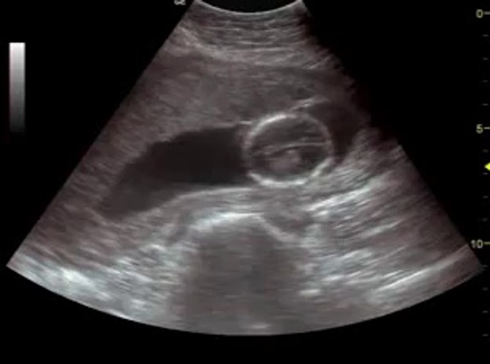 Что происходит на 17 неделе беременности