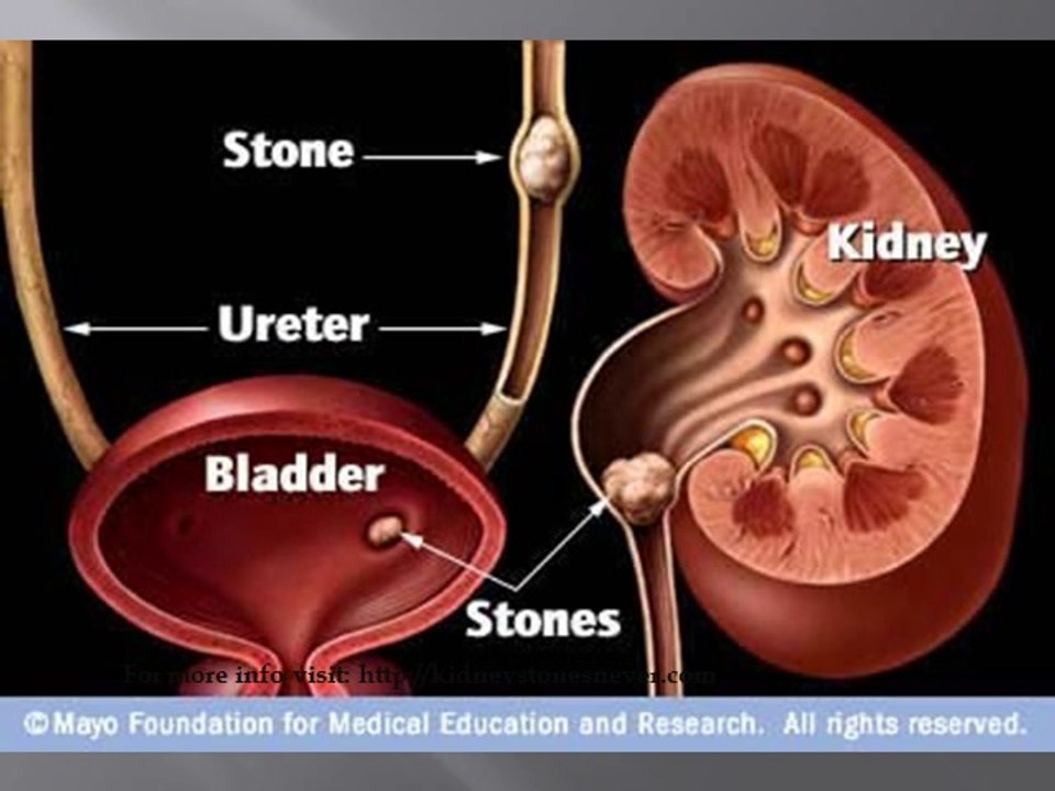 Types of Kidney Stones