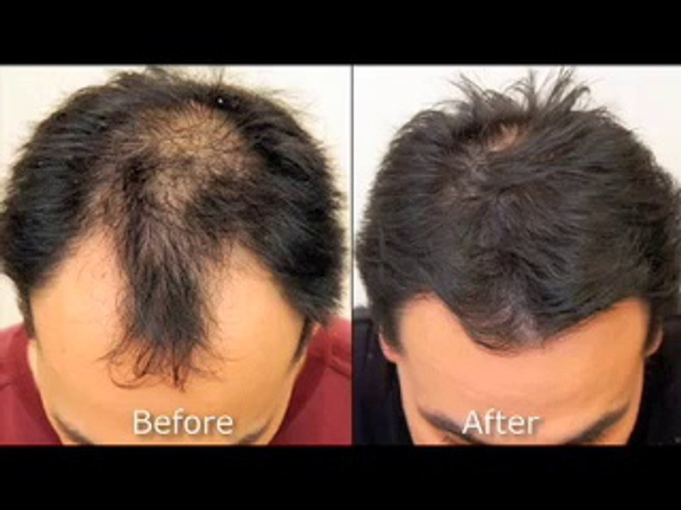 Neograft Long Island | American Hair Restoration Long Island