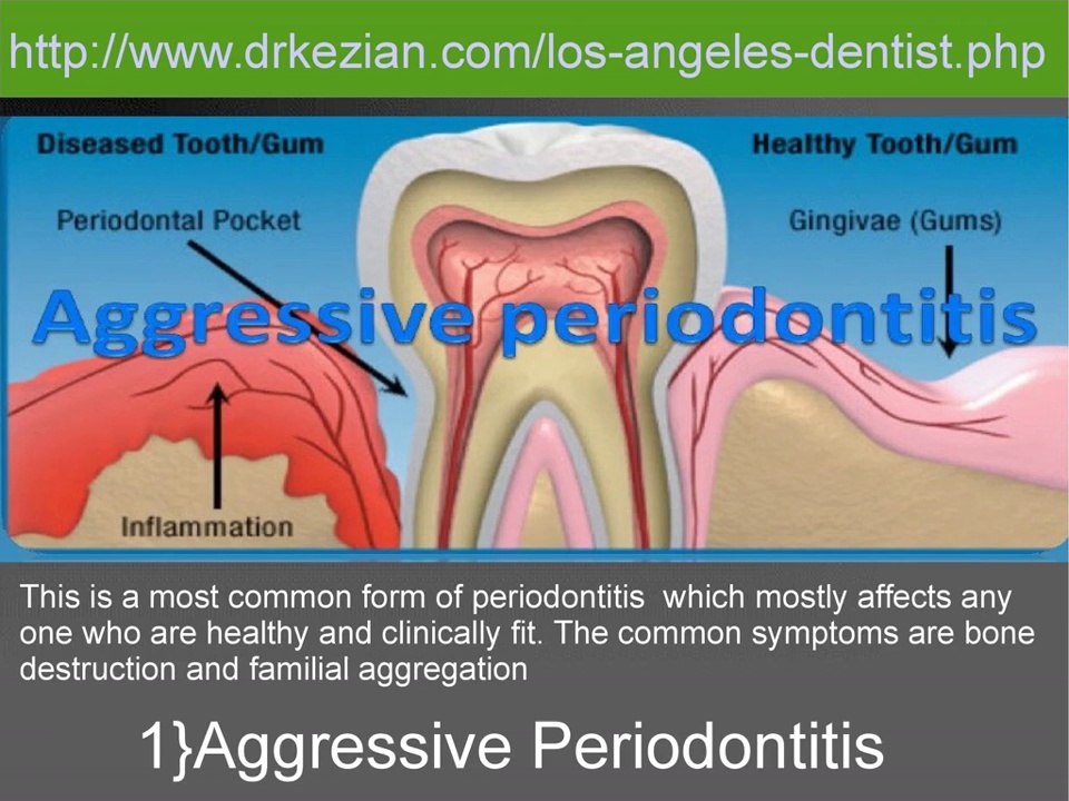 Periodontitis Disease And Its Types
