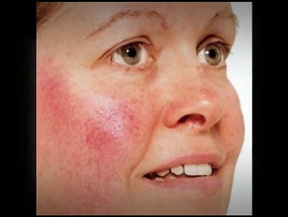 Different Types of Rosacea Symptoms