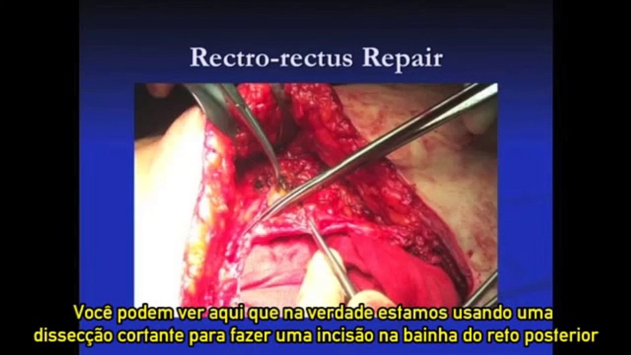 Revisão de técnicas de cirurgia de Hernia Ventral aberta