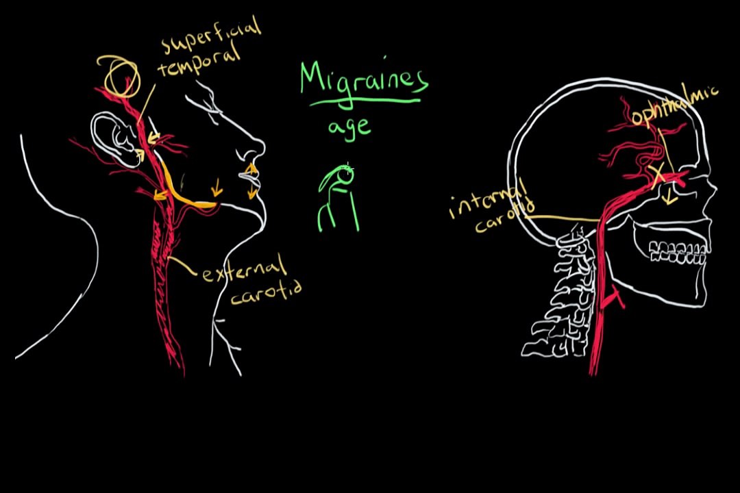 Temporal Arteritis