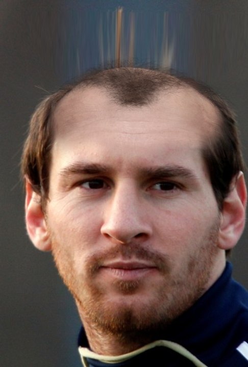 Messi Bald, Messi Calvo