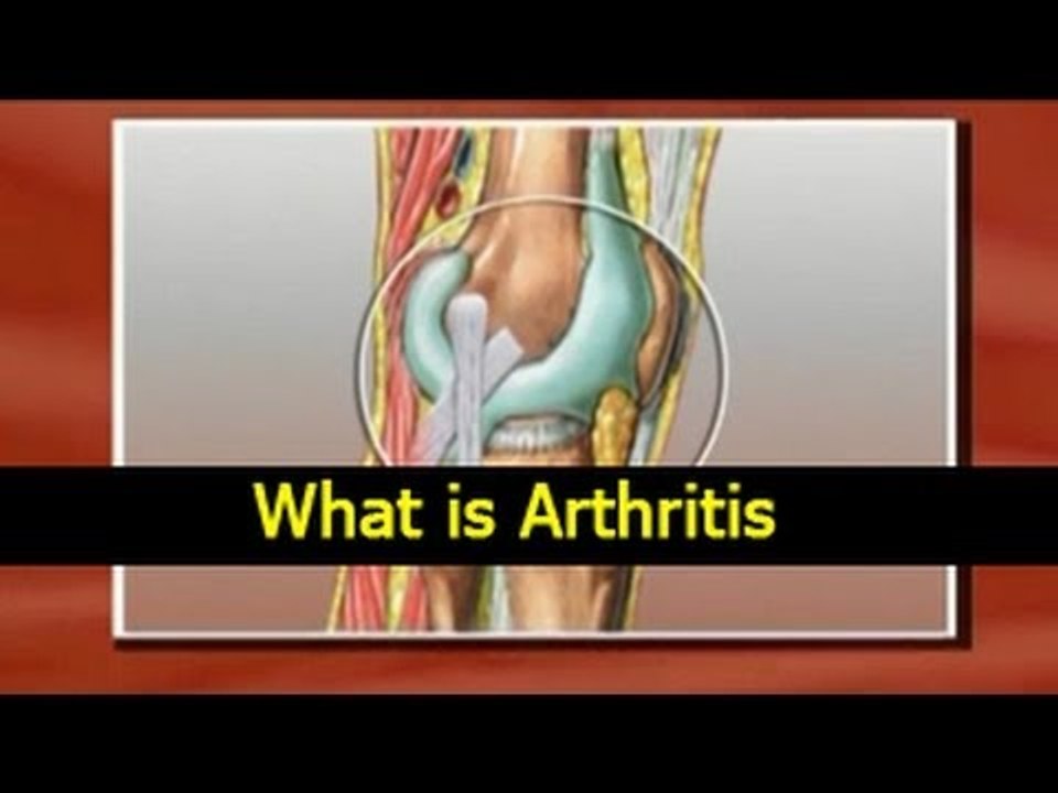 What is Arthritis - Causes, Symptoms, Treatments and Diet Tips in English