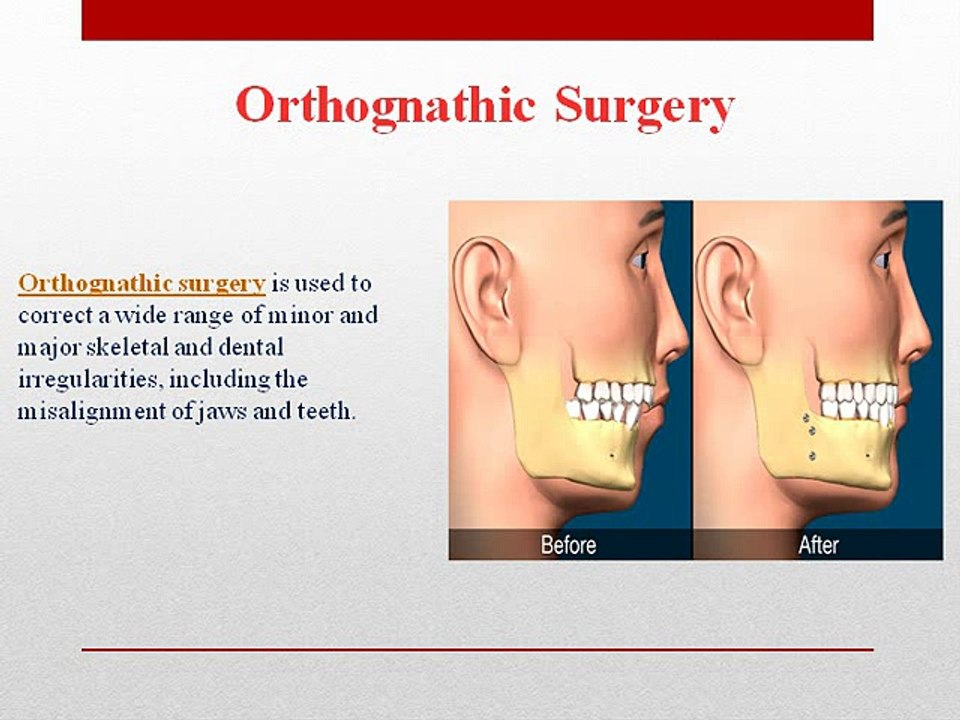 orthognathic surgery and its types
