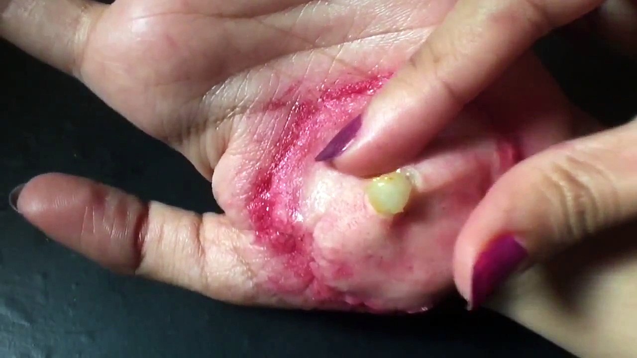 Pimple popping |sfx makeup In English