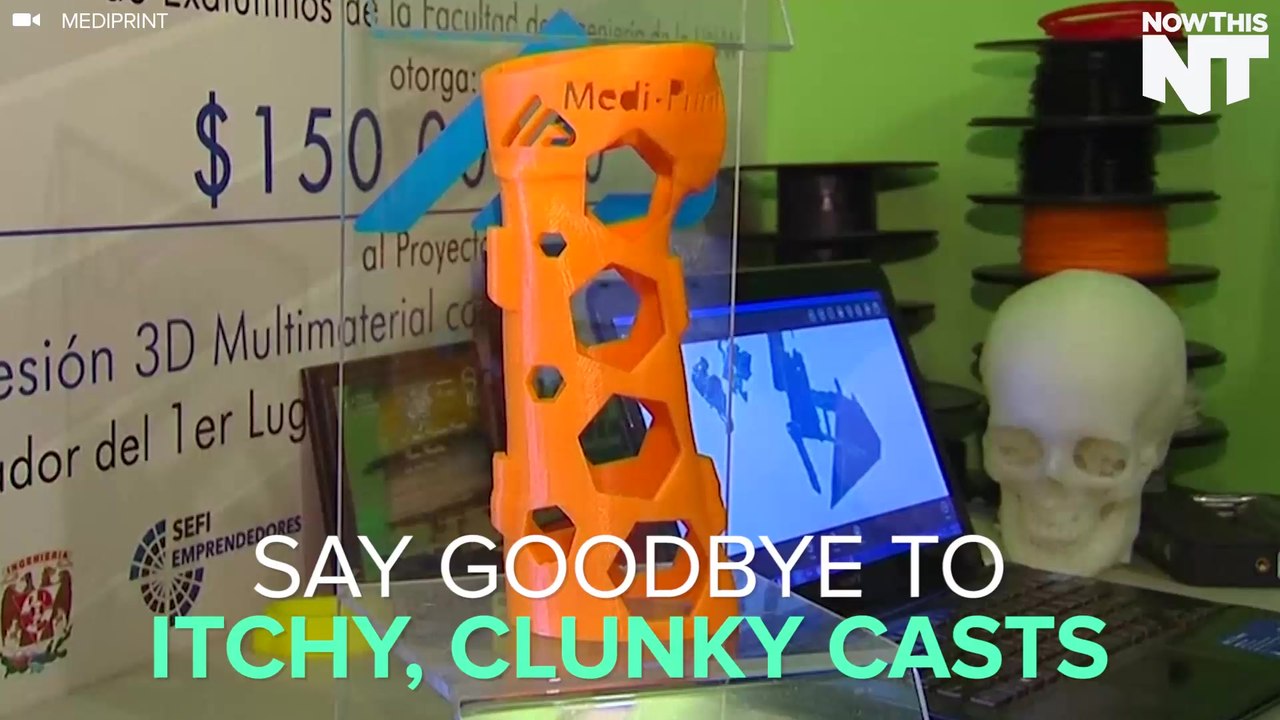 3D Printed Waterproof Casts