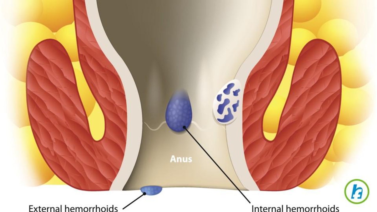 What are Hemorrhoids?