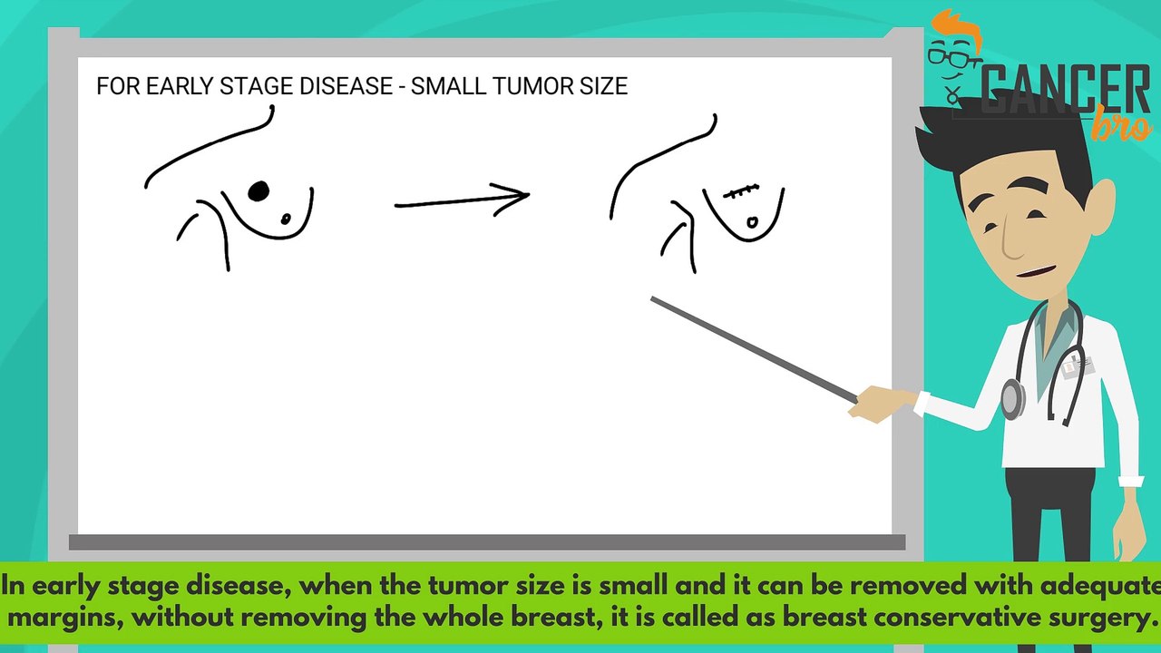CancerBro explains types of breast cancer surgery