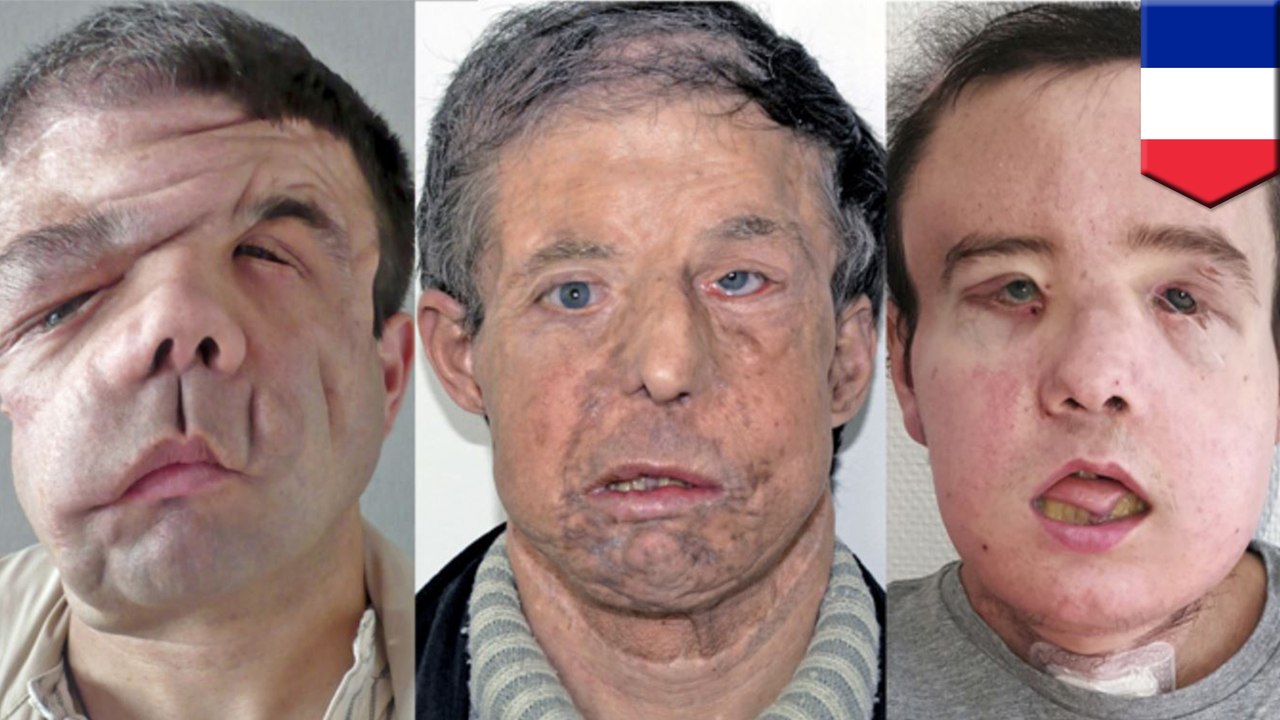 'The man with three faces': What is neurofibromatosis type one?