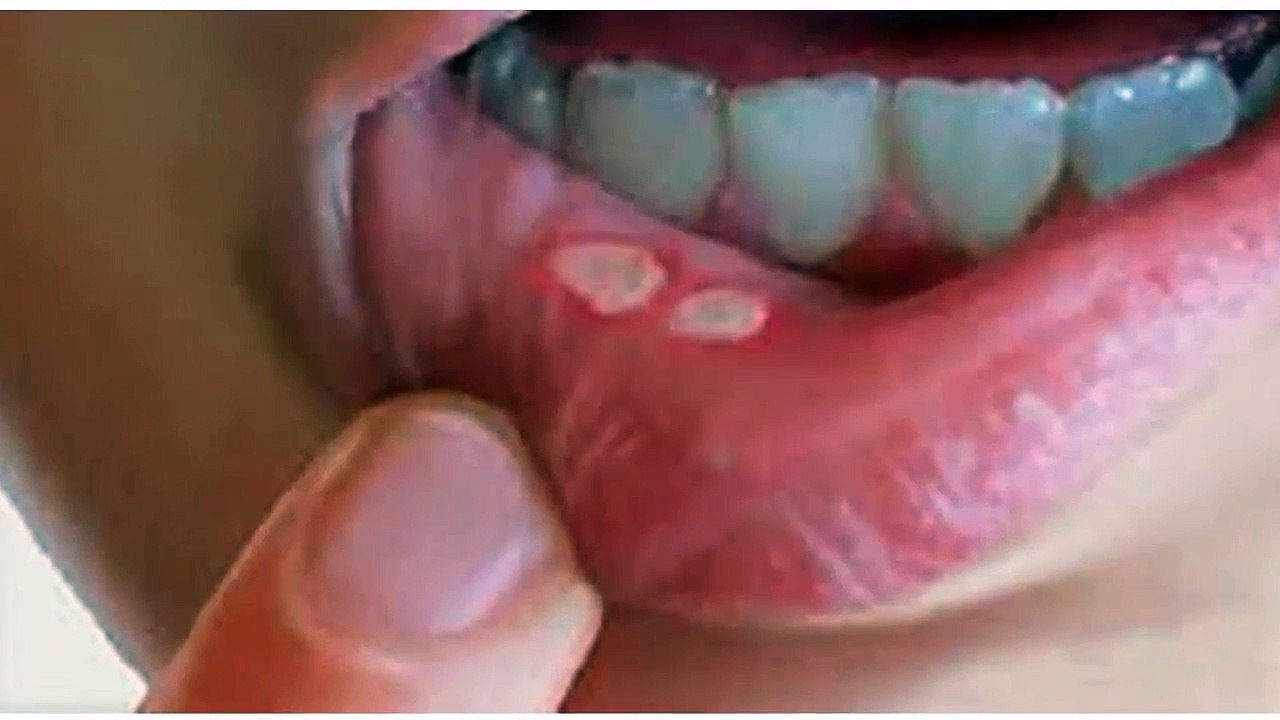 Canker Sores In The Mouth: Here Is How To Naturally Get Rid Of Them In A Matter Of Minutes