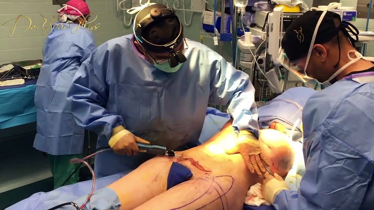 Hip  asymmetric after hourglass hip