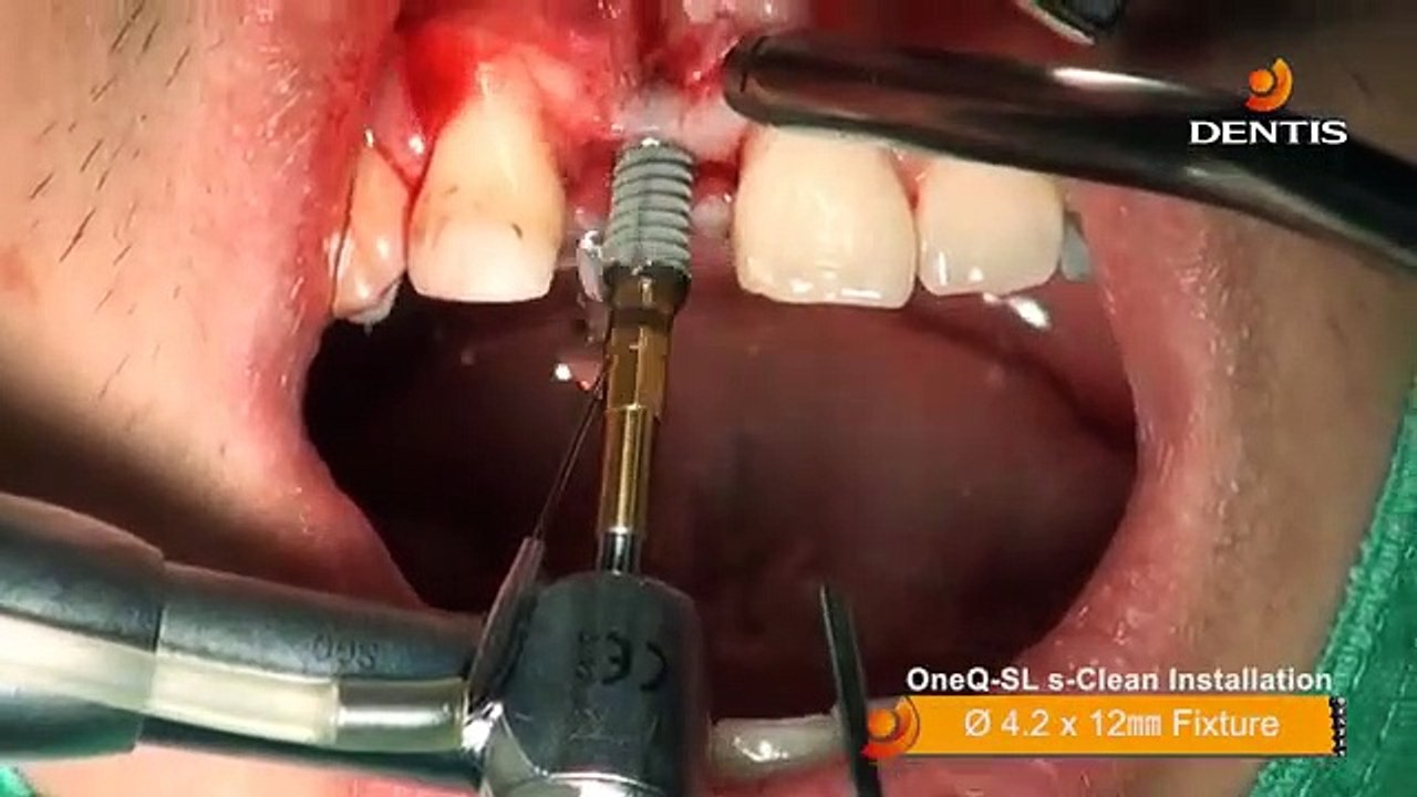 ایمپلنت | کلینیک دندانپزشکی تاج