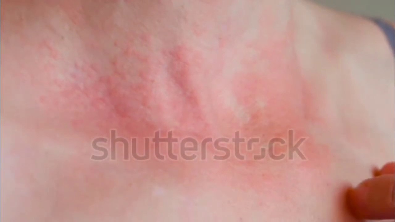 'दाद-खाज और खुजली' से पूरी तरह से छुटकारा पाने के लिए [Sapat Lotion] का इस्तेमाल करें #fungal