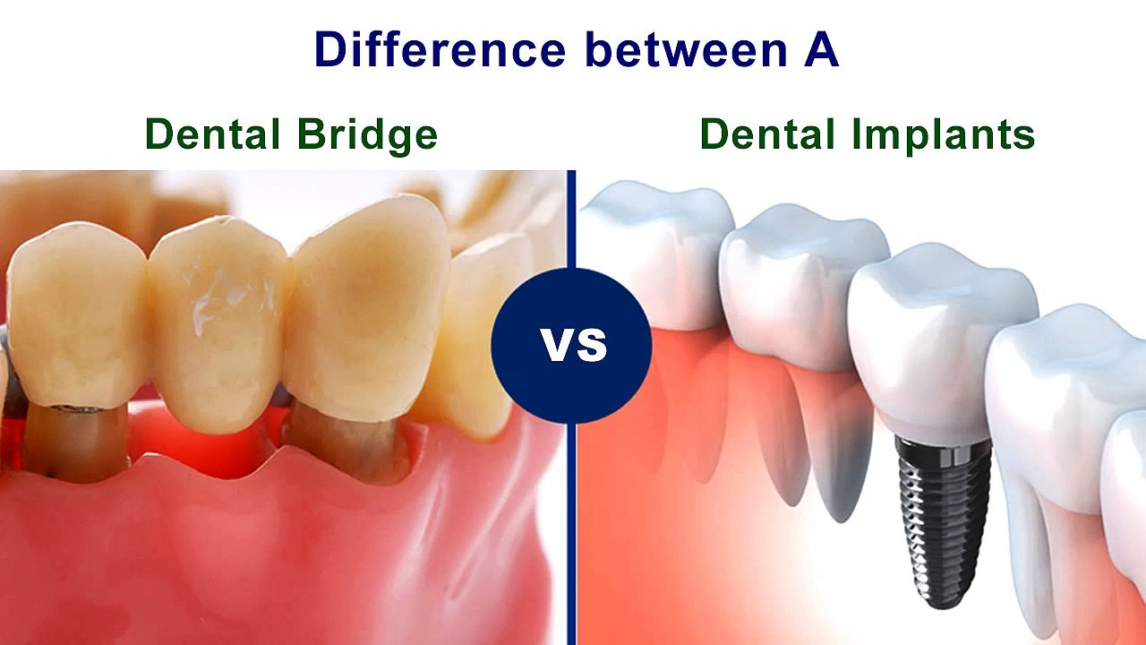 Difference Between A Dental Bridge and Dental Implants