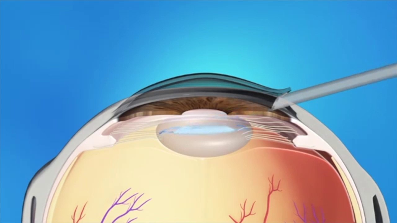 Cataract Surgery - Step by step