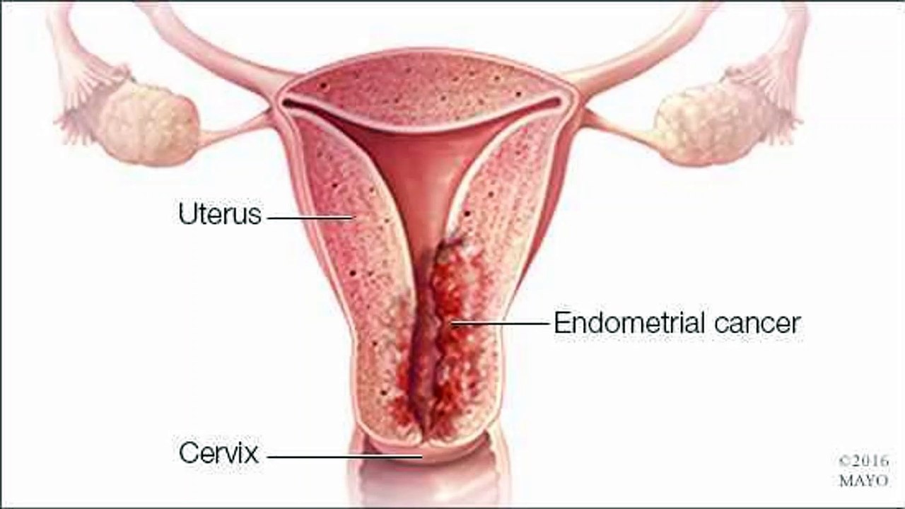 What Is Endometrial Cancer