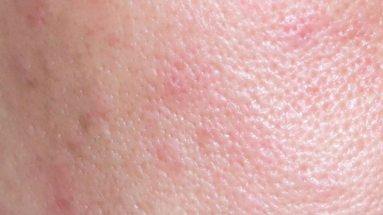 What is post-inflammatory erythema and how to treat it