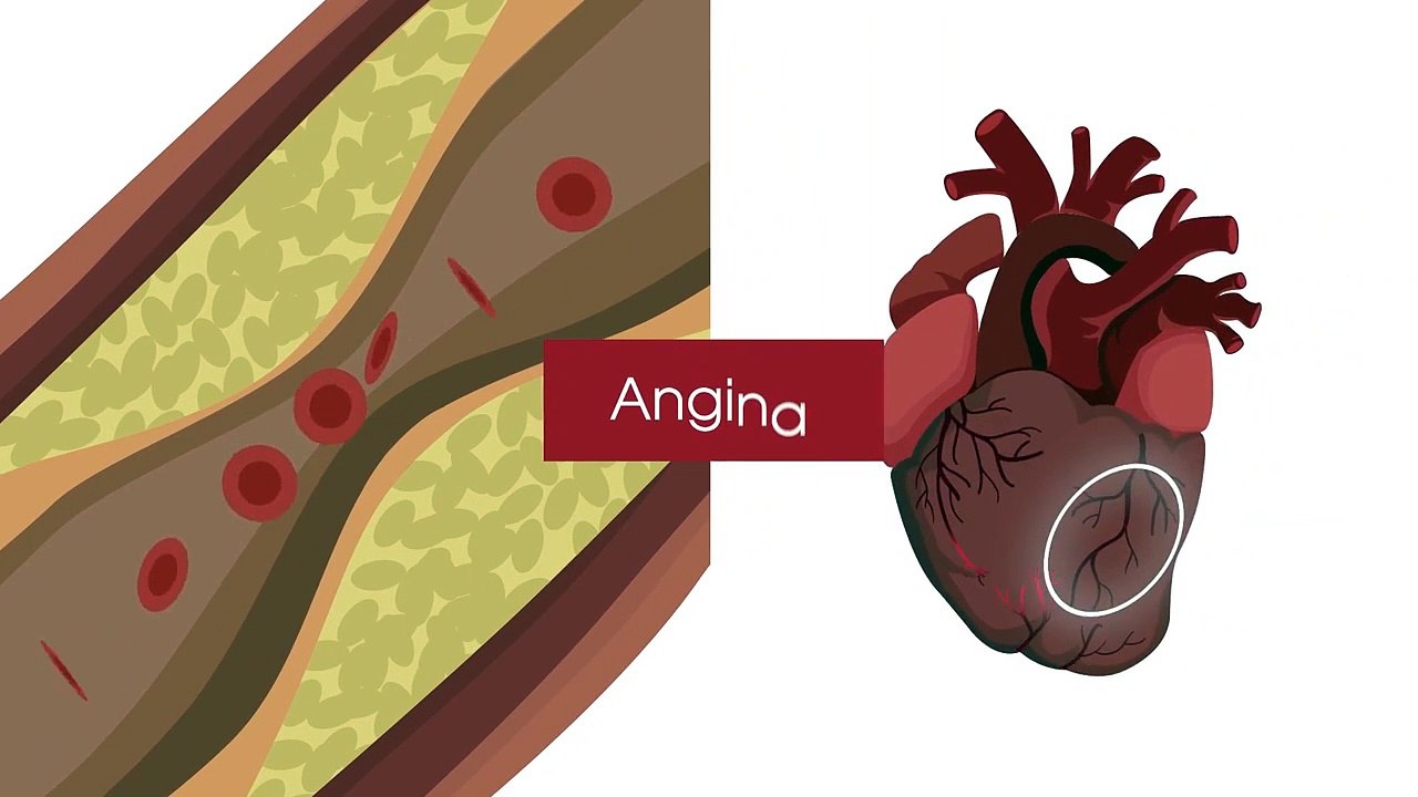 What is a heart attack? | March 15, 2022 | ACM