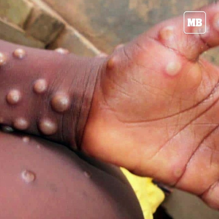 What is Monkeypox