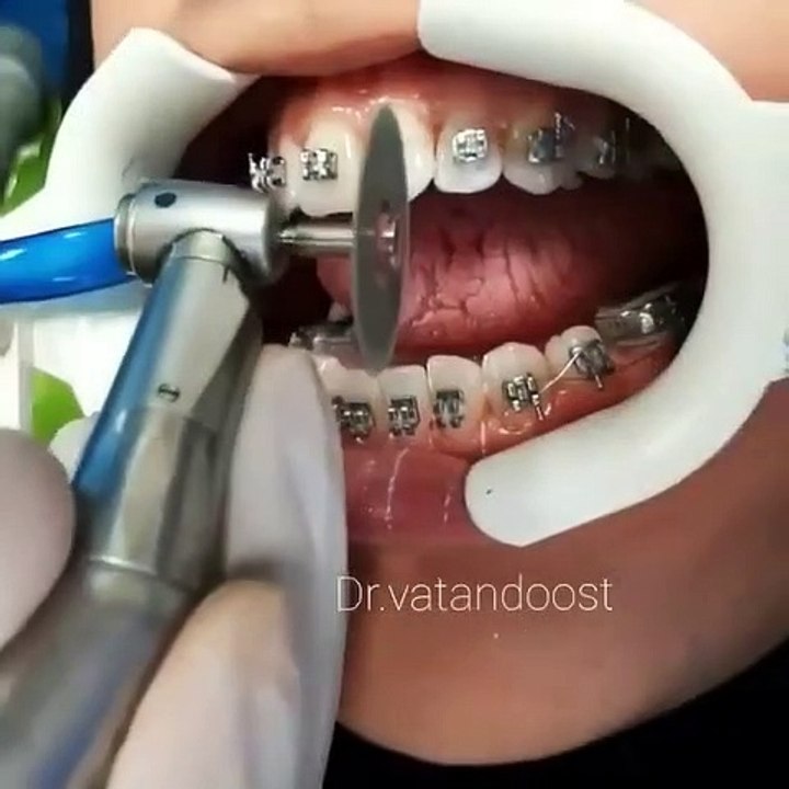 Interproximal reduction | Tooth reduction