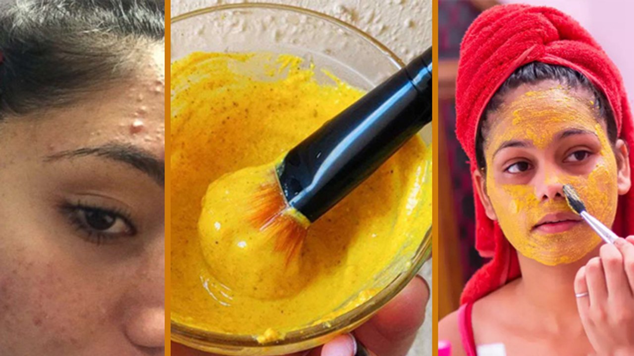 Pimples हटाने के लिए बेसन Face Pack इस तरीके से लगाएं | मुंहासों के लिए ऐसे लगाएं बेसन | Boldsky