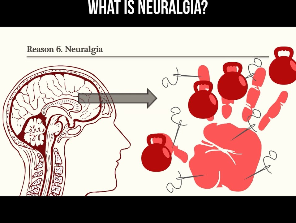 What is neuralgia?