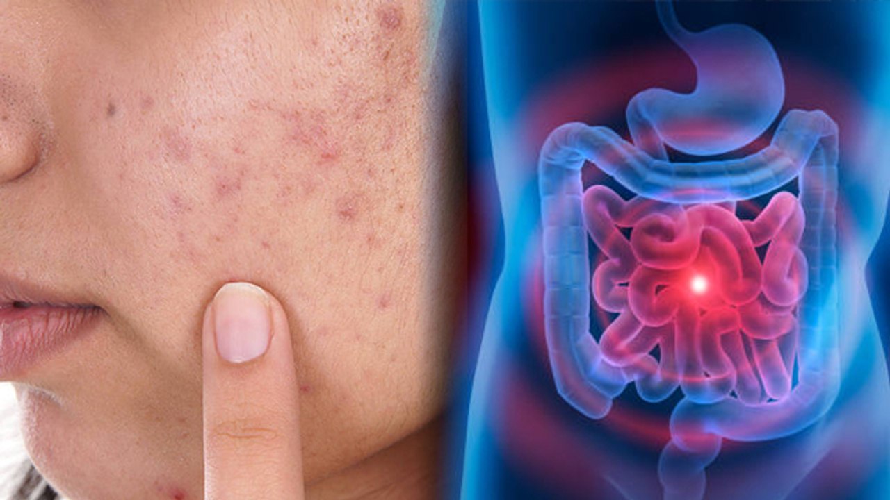 गाल पर पिम्पल क्यों होते है, गाल पर पिम्पल होने का कारण | Boldsky