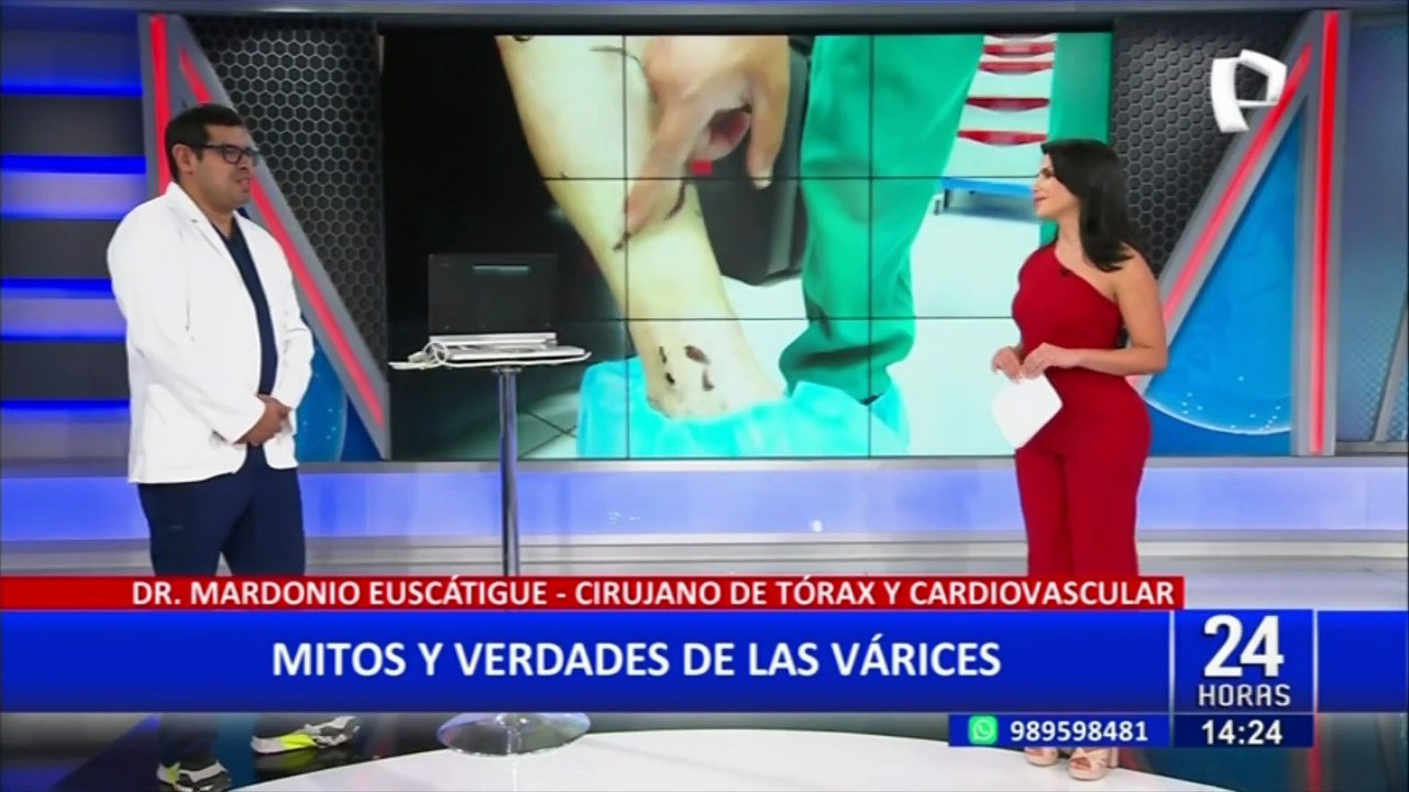 Várices: conozca como tratar y prevenir este problema sanguíneo