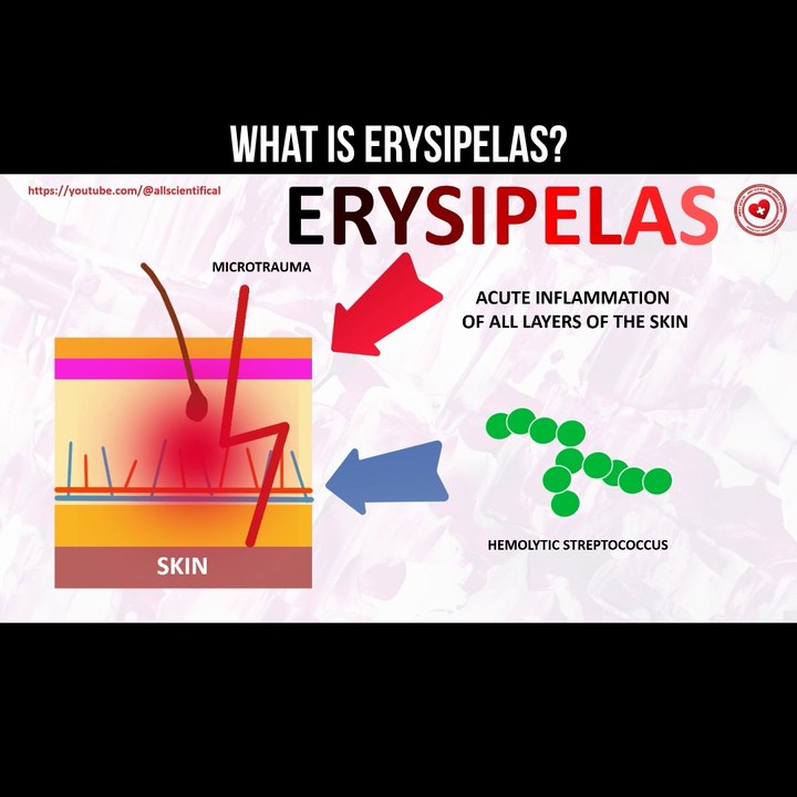 What is erysipelas?