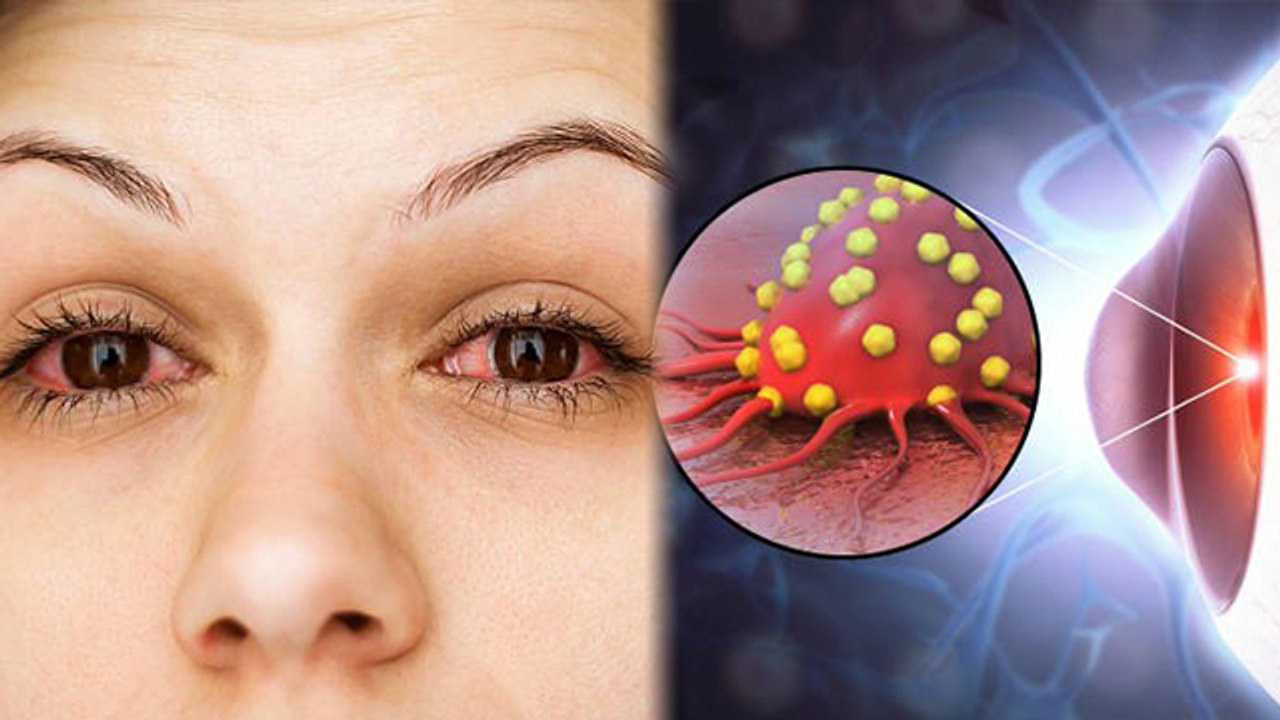 आई फ्लू क्यों फ़ैल रहा है | Eye Flue Kyu Fail Raha Hai | Eye Flu Kaise Thik Kare |  | Boldsky