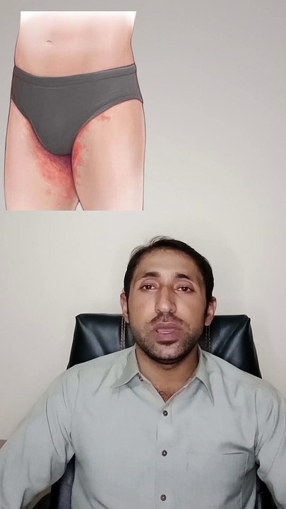 Fungal infection i private parts   tinea cruris   jock itch