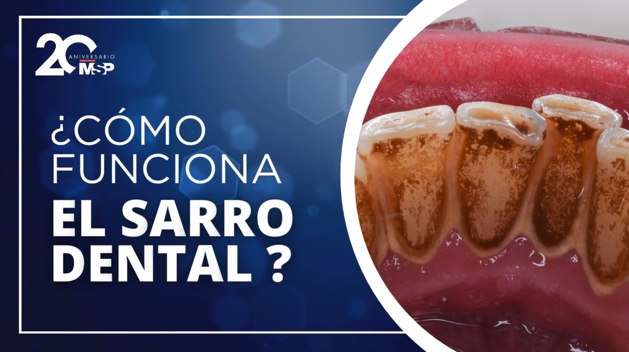 ¿Cómo funciona el sarro dental?