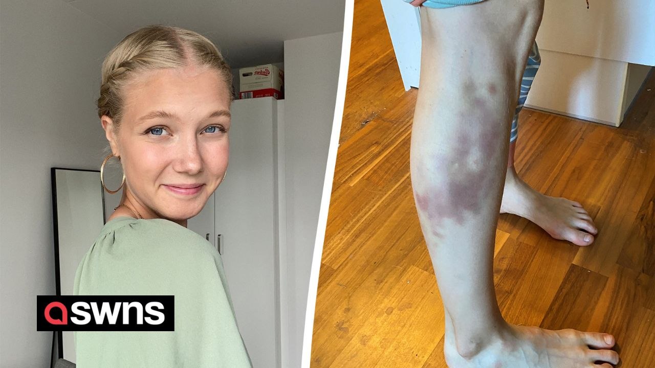 "I bruise so badly teachers thought I was being abused as a child - but it was rare condition"