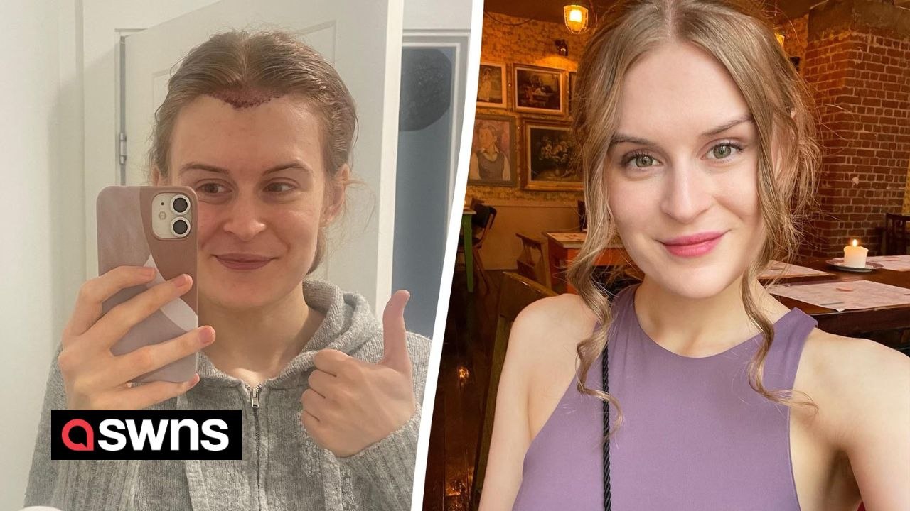 Identical twin has two hair transplants so hairline matches sister's - and it cost £5.5k