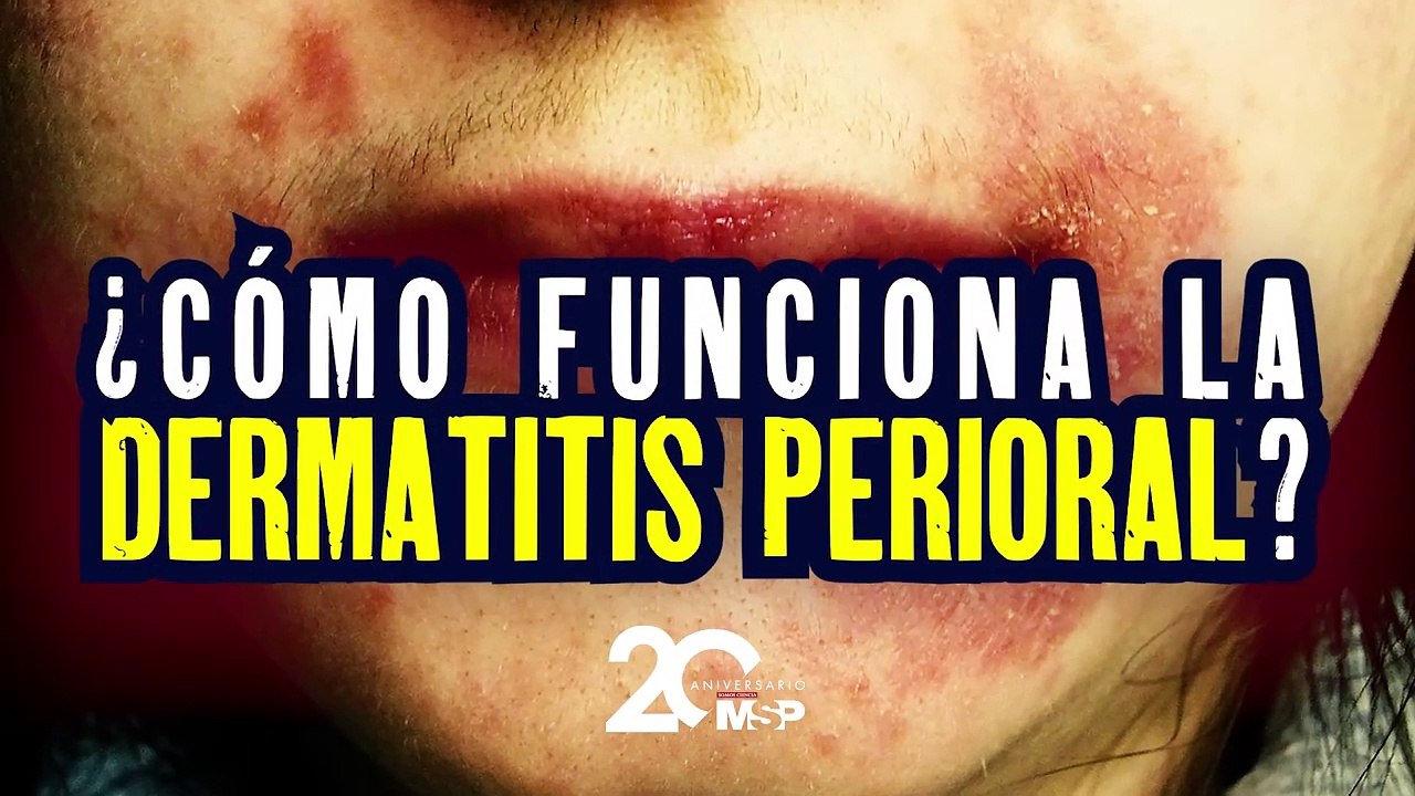 ¿Cómo funciona la dermatitis perioral? - #EspecialMSP