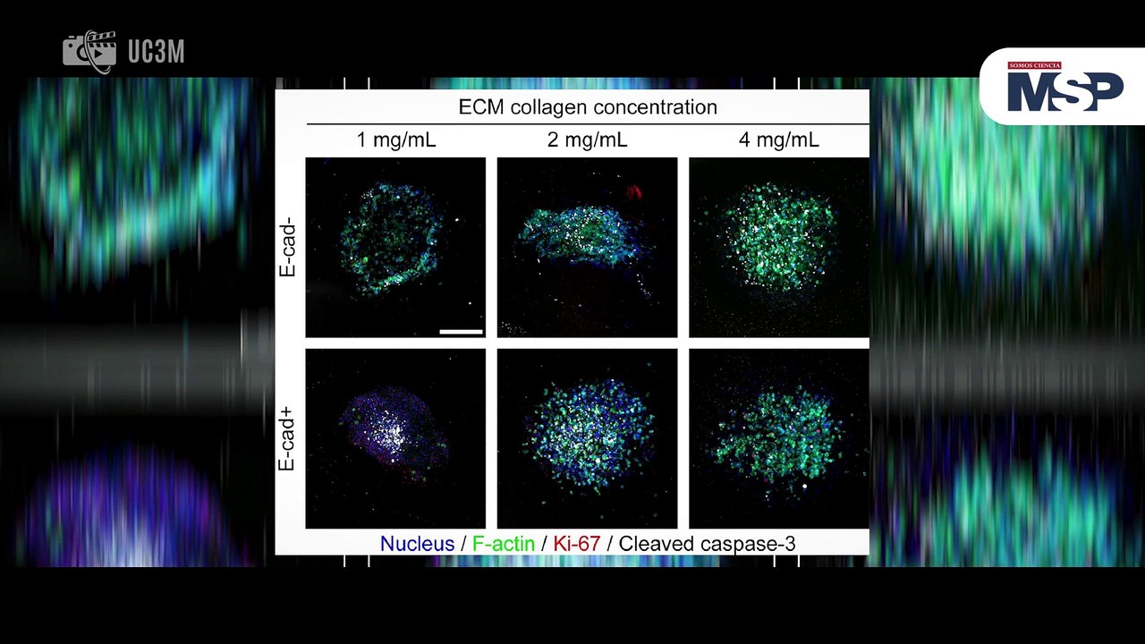 Simulación computacional predice la evolución de tumores en cáncer de mama - #ExclusivoMSP