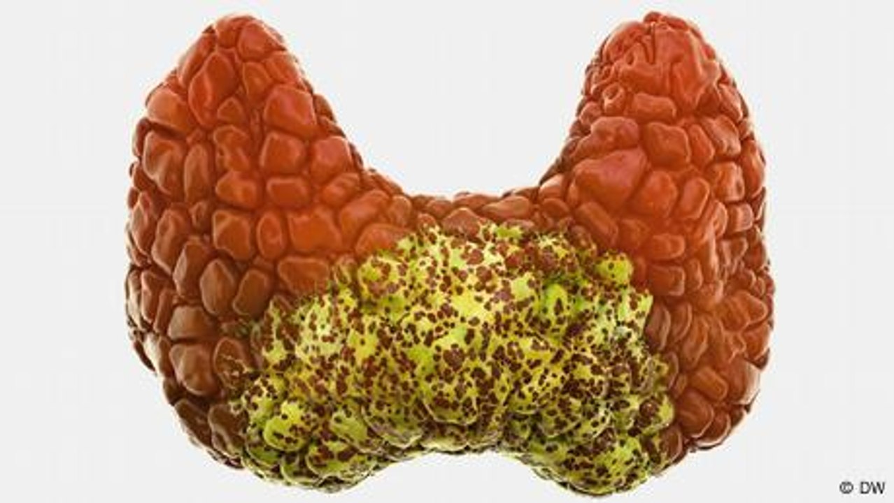 What is an underactive thyroid?