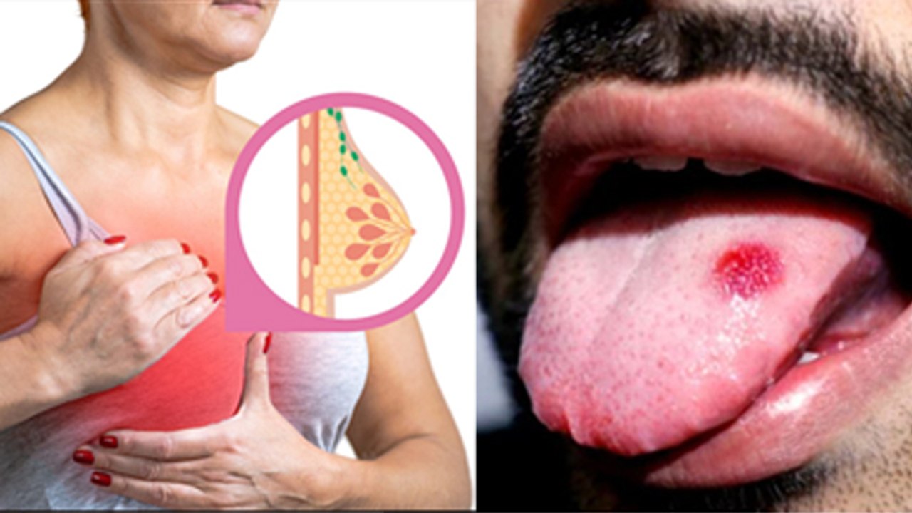 Breast Cancer To Lung Cancer Young Age में किसका High Risk, Cancer In Young Age Reason