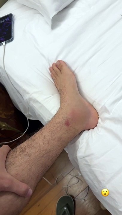 Nattanzinho toma celularzada em show e mostra estrago no tornozelo