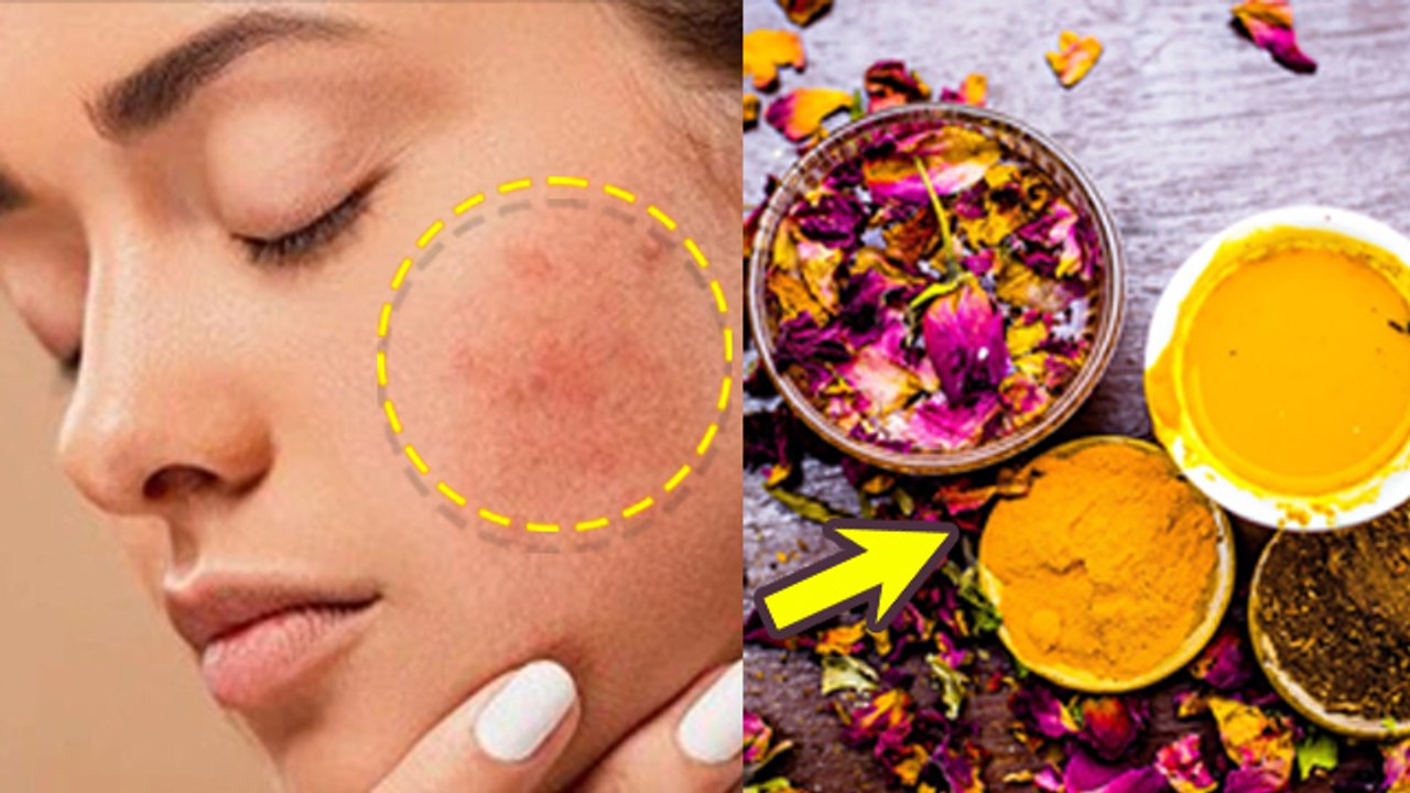 Chehra Lal Ho Jaye To Kya Kare| Skin Redness Treatment Home Remedies |Boldsky