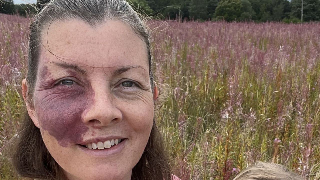 "I covered my birthmark for 34 years but now I don't want to hide from my kids"
