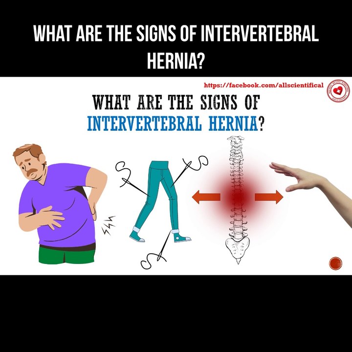 What are the signs of intervertebral hernia?