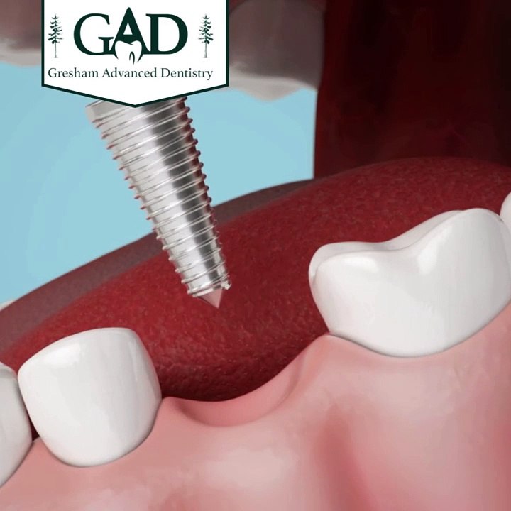 What Are Dental Implants and How Do They Work?