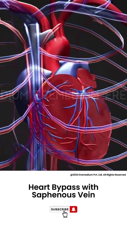 Heart Bypass With Saphenous Vein