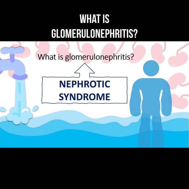 What is glomerulonephritis?