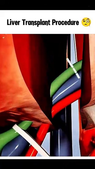 How a Liver Transplant Works: Step-by-Step 3D Animation Explained  #LiverTransplant #3DAnimation #MedicalAnimation