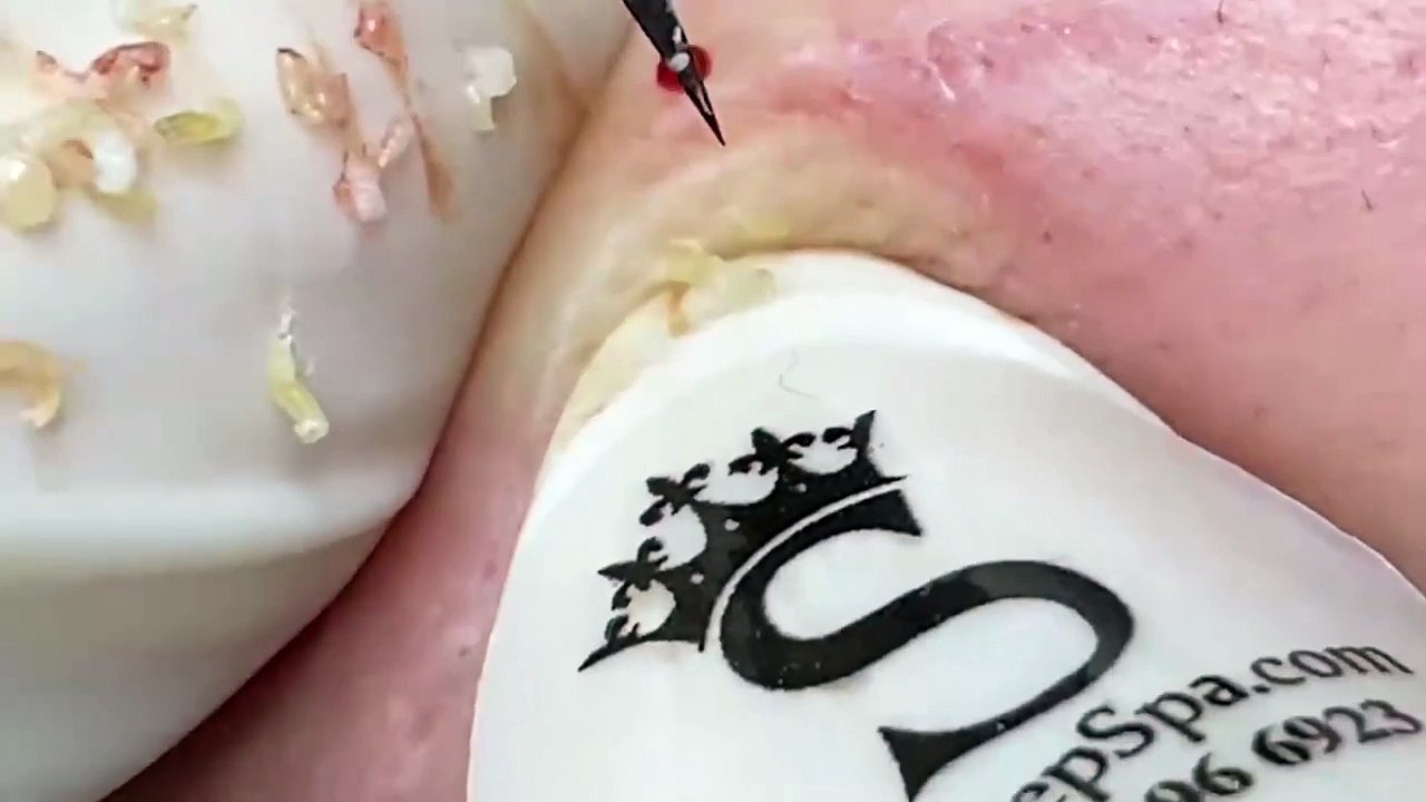 Best Blackhead Removal Tools! (Easy to Use at Home)