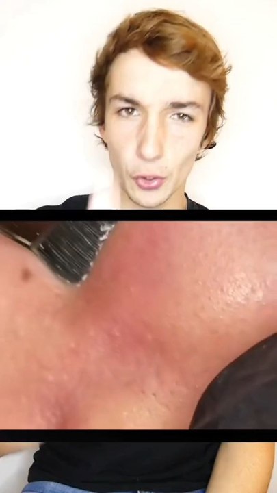 Filaments sébacés 🤯